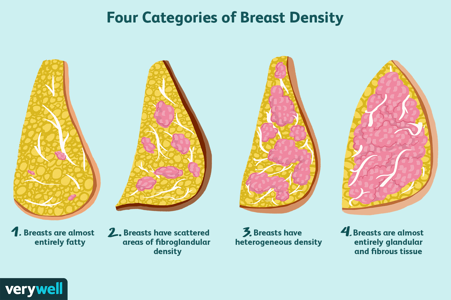 Seins denses et risque de cancer du sein 