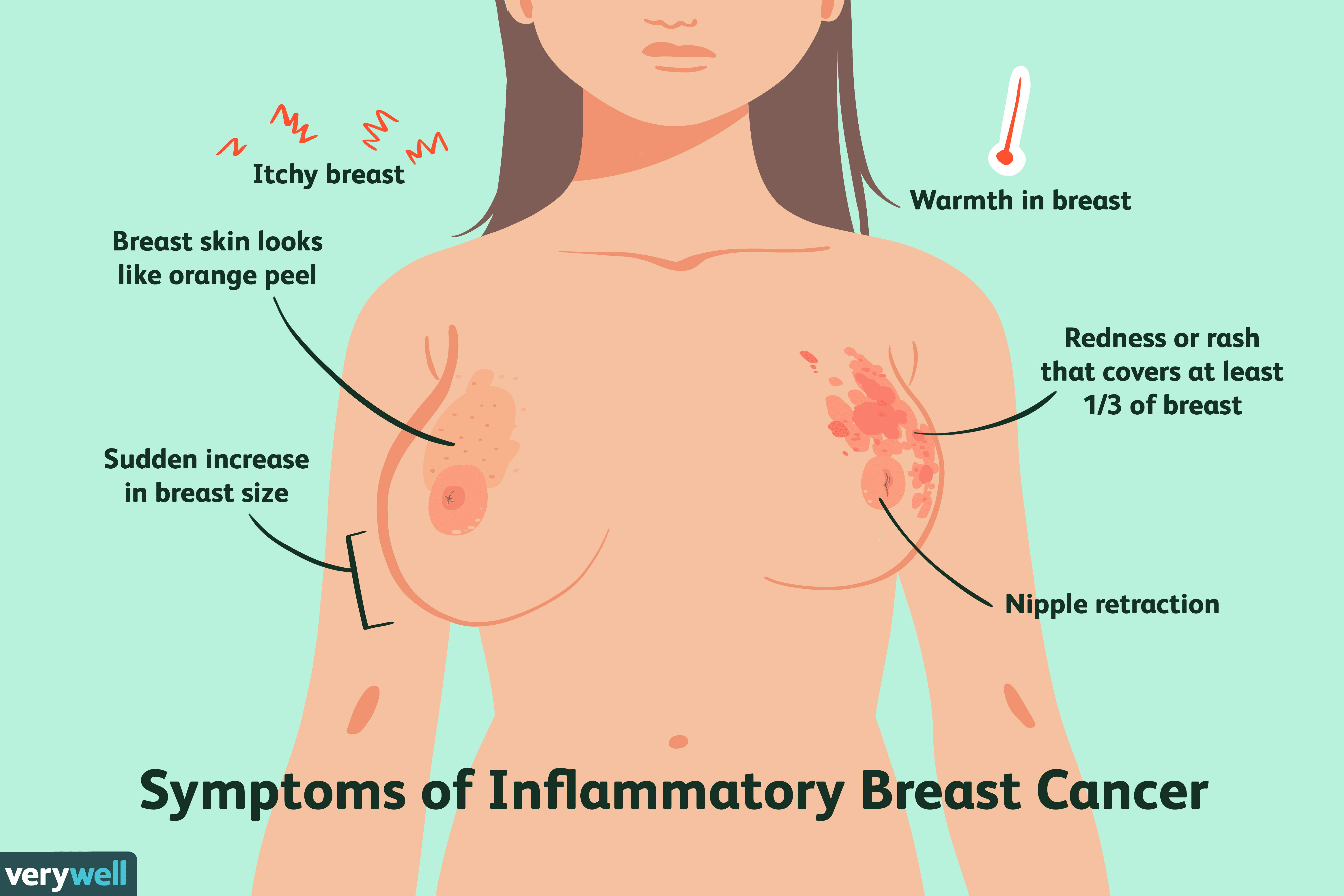 Types de cancer du sein 