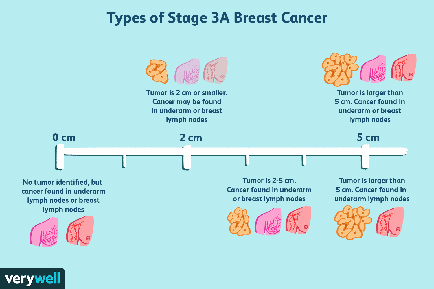 Una descripción general del cáncer de seno en etapa 3 