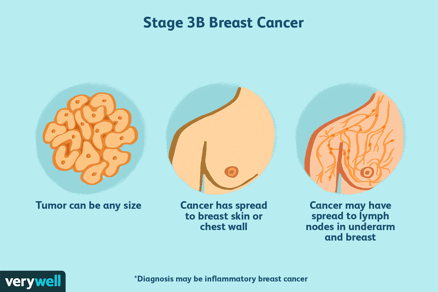 Una descripción general del cáncer de seno en etapa 3 