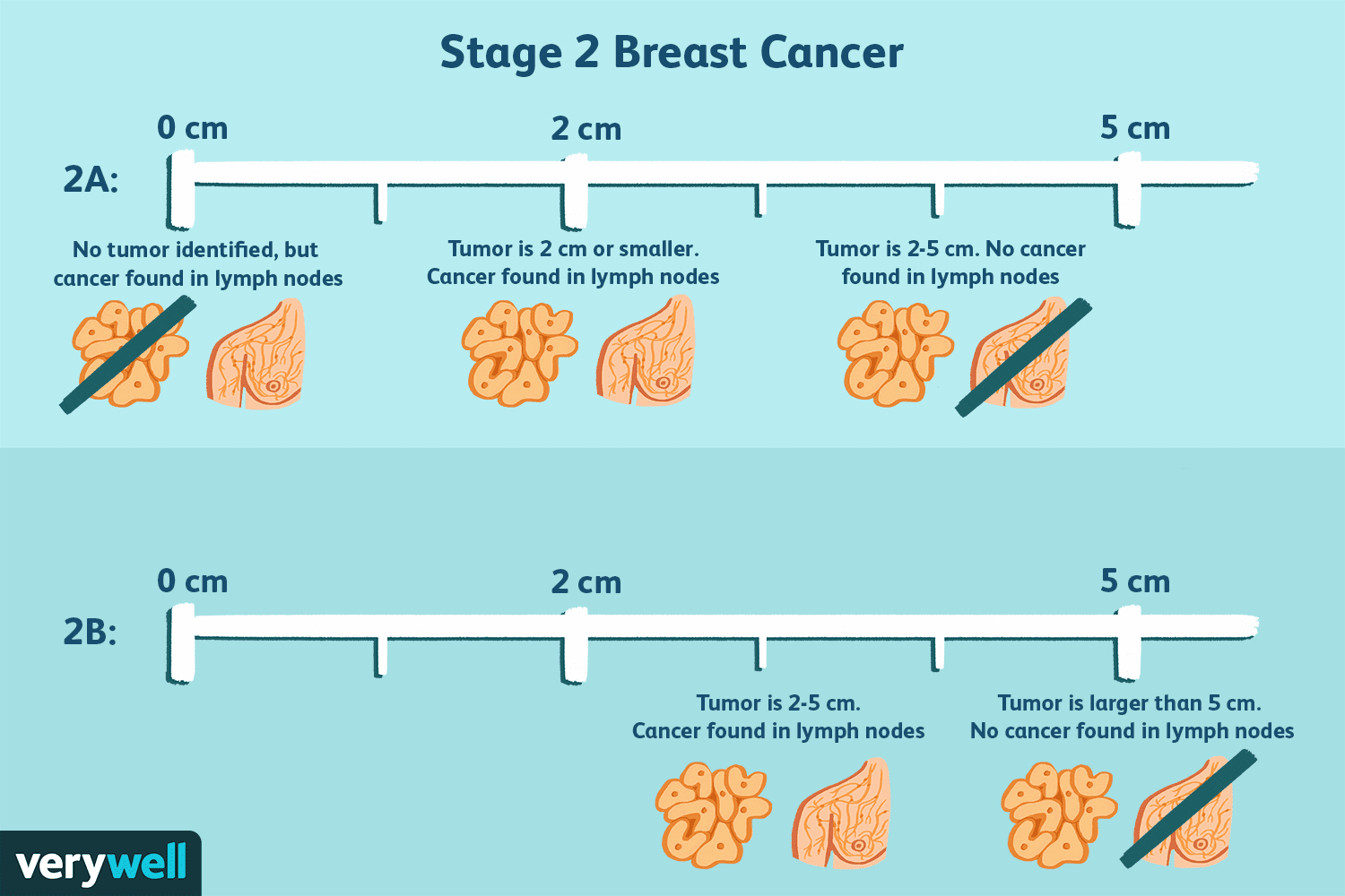 Una descripción general del cáncer de mama en etapa 2 