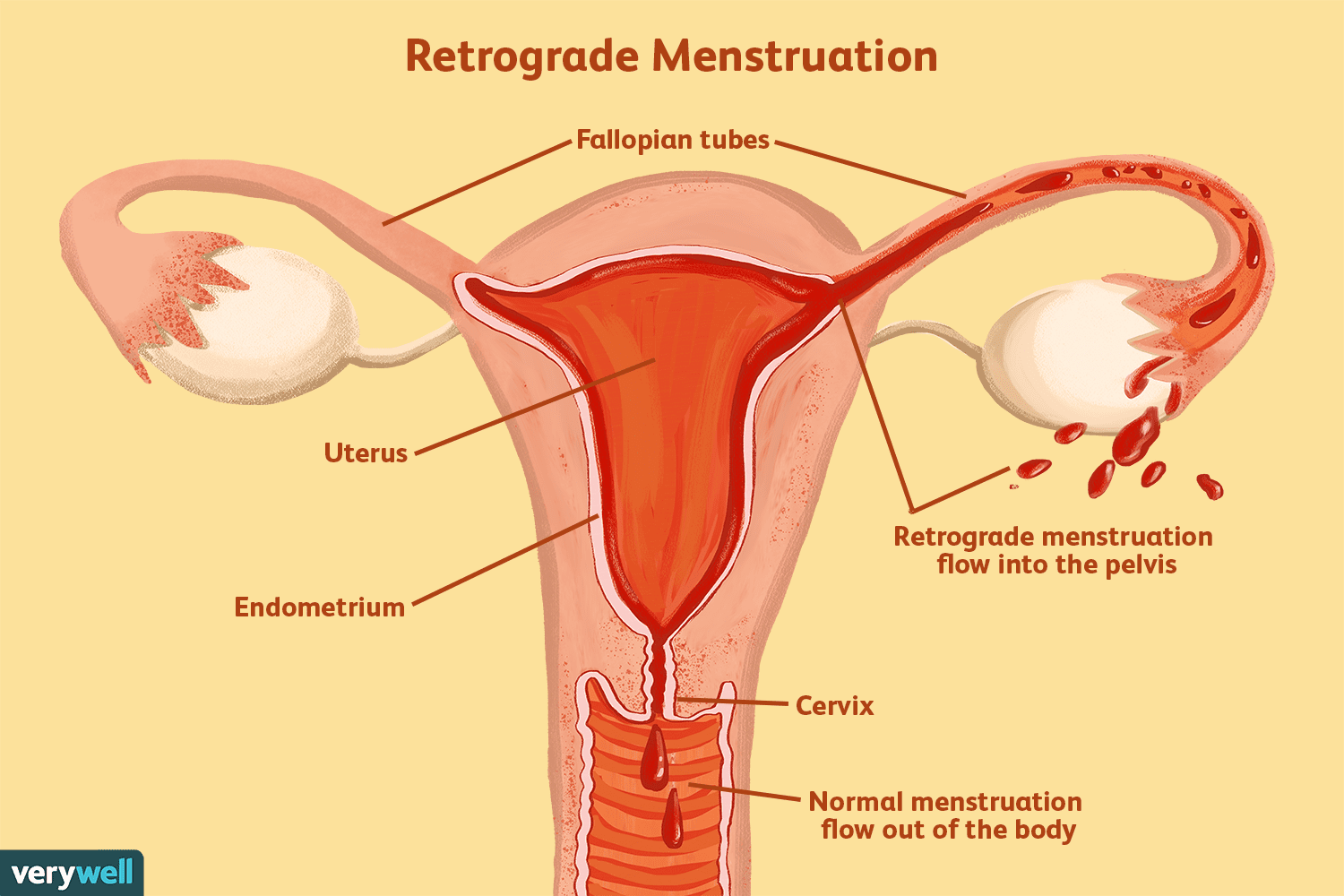 Uma visão geral da menstruação retrógrada 