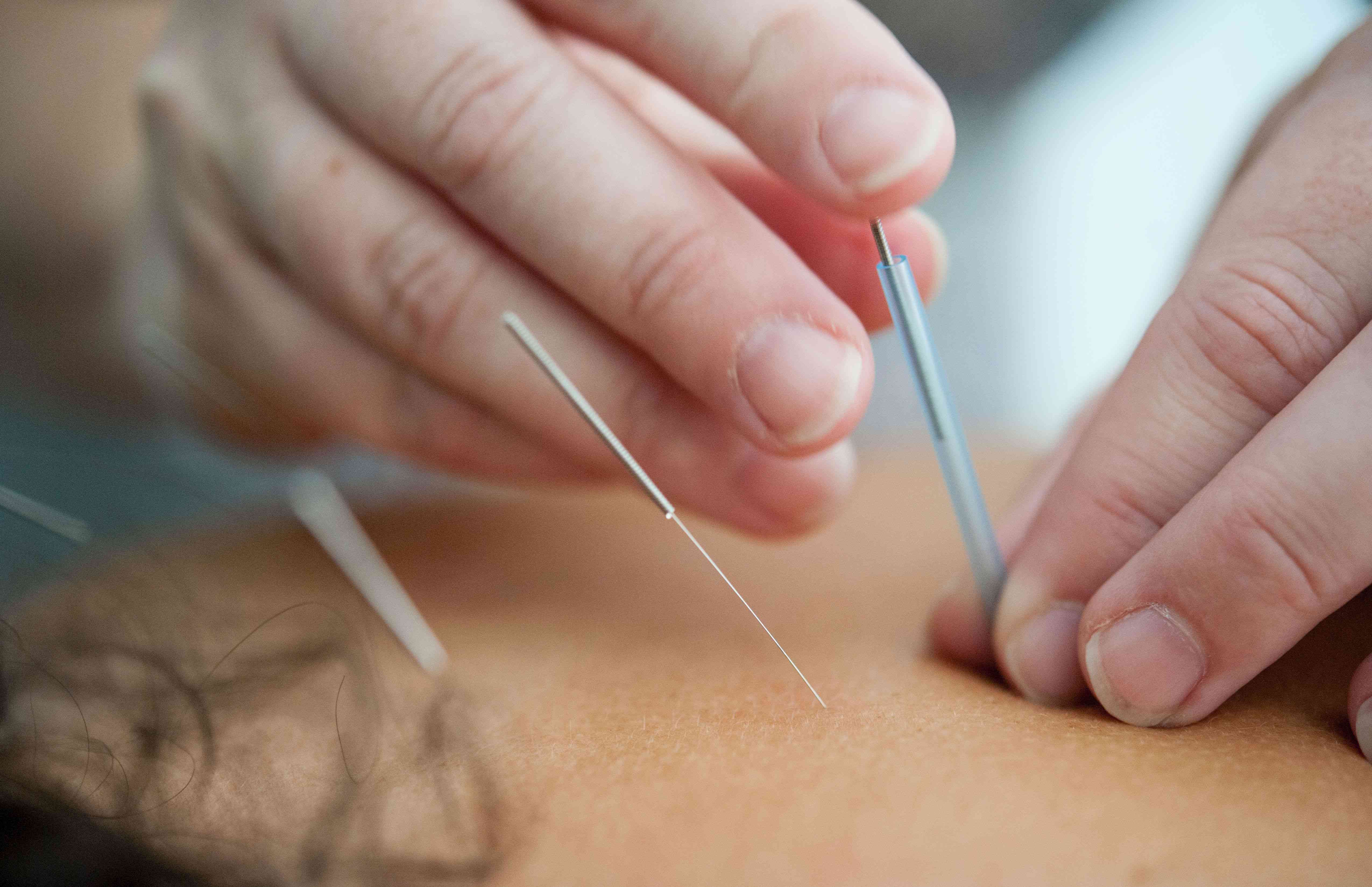 Acupuncture pour la perte de poids 