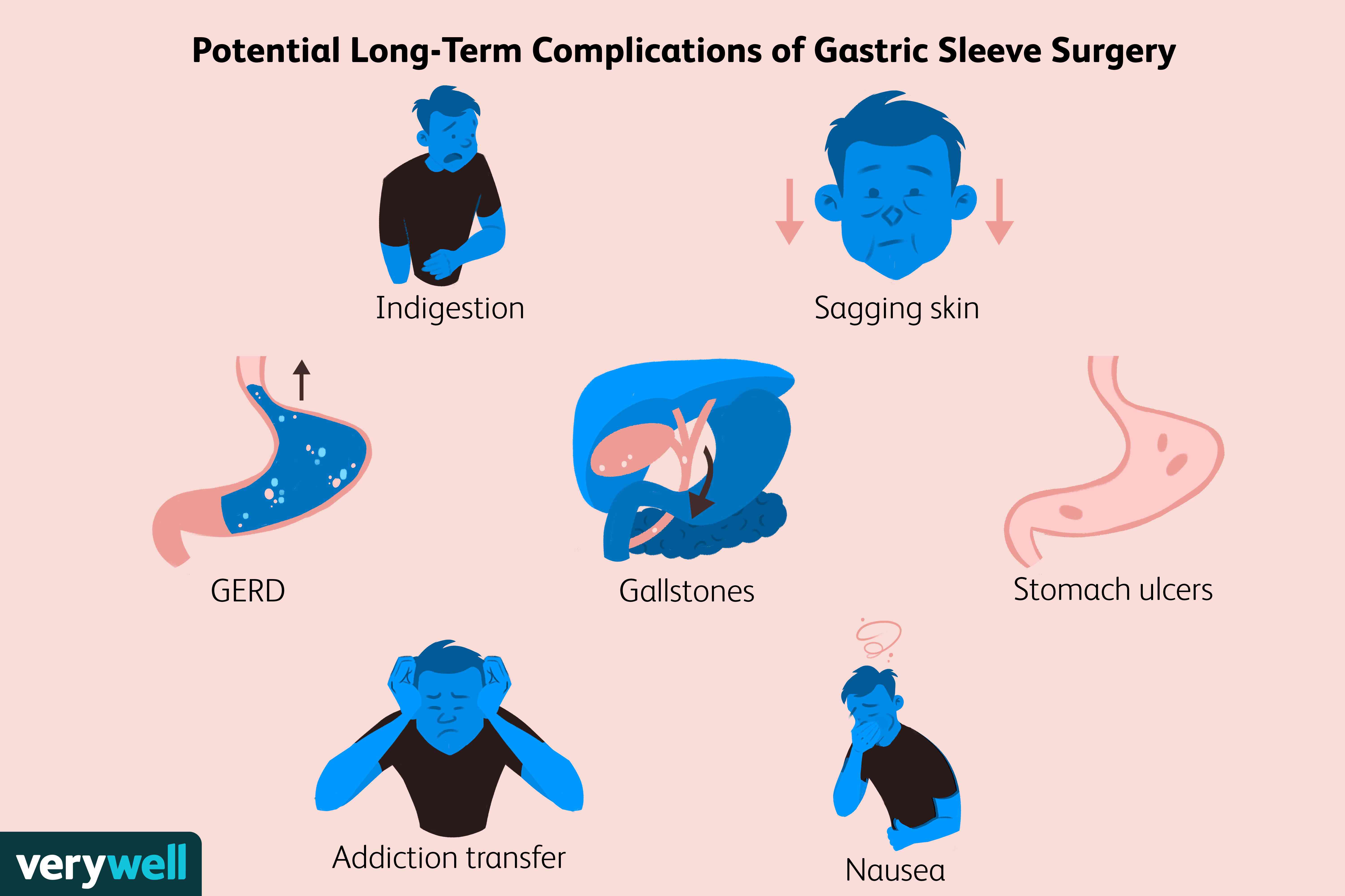 Complications à long terme après une chirurgie des manches gastriques 