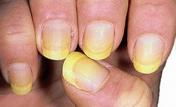 Comment traiter les outils de manucure de Nail Fungus? Champignon de l ongle après traitement de manucure. 