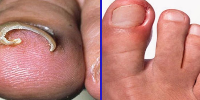 Comment traiter les outils de manucure de Nail Fungus? Champignon de l ongle après traitement de manucure. 