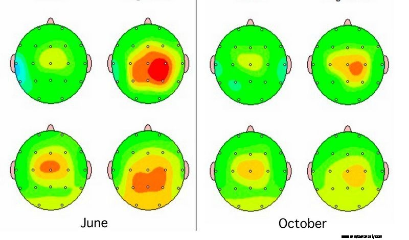 Beneficios de la terapia de neurofeedback para la atención, la creatividad, el alivio del sueño y el estrés 