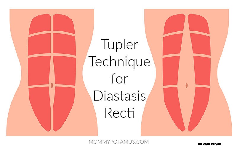 Granskning:Tupler -teknik för Diastasis Recti -återhämtning 