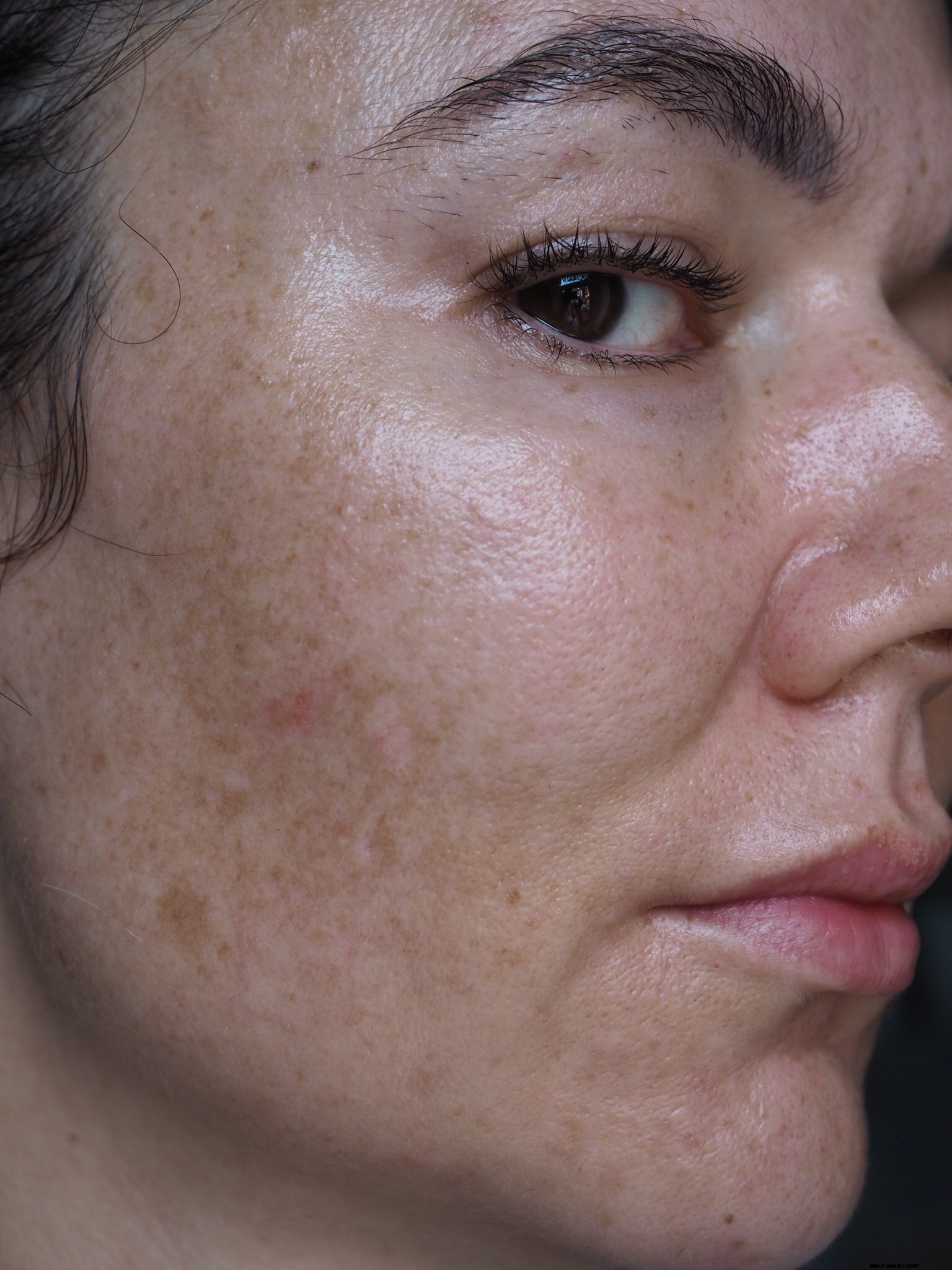 Melasma und Pigmentierung mit dem Gewöhnlichen behandeln 